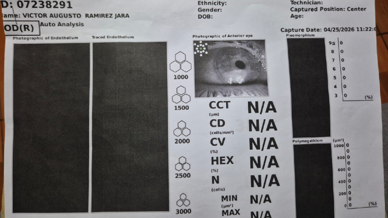 glaucoma-ino-adulto2_276736.jpg